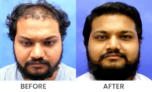Best Hair transplant in India