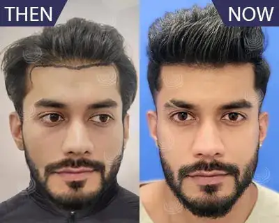 Hair Transplant in Goa Evolve Cosmetic Clinic Book Appointment at  9819685222  YouTube
