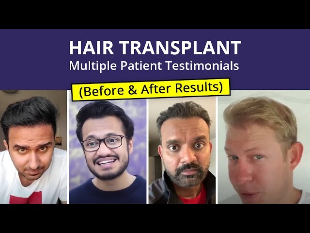 MedLinks hair transplant Patient from India