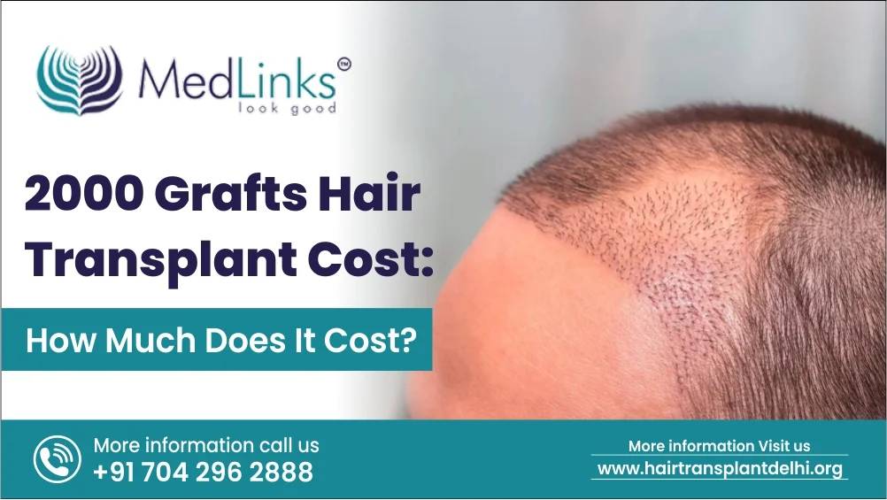 2000 grafts hair transplant outlet cost