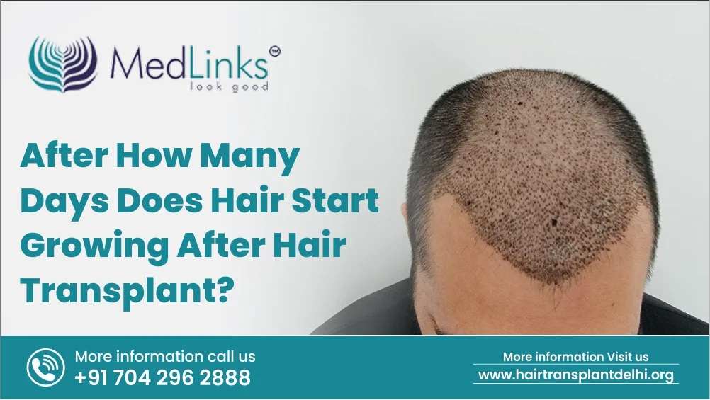 After How Many Days Does Hair Start Growing after Hair Transplant?