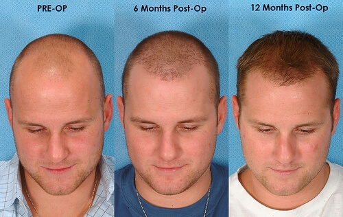 All You Want To Know About Hair That Grows After Hair Transplant - Medlinks