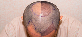What does Redness after Hair Transplant Indicate?