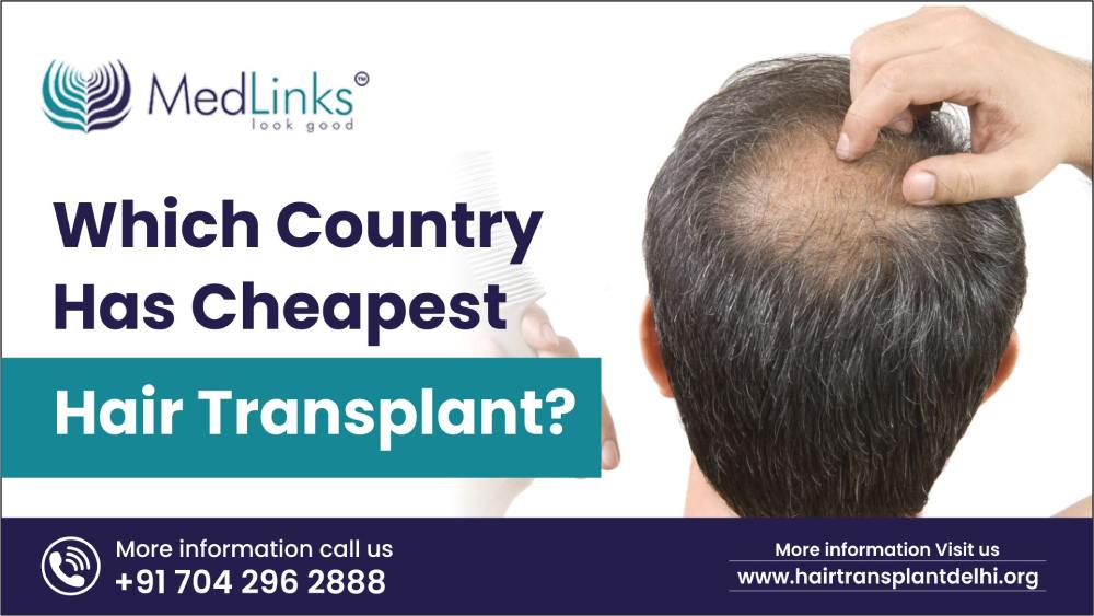 Is A Hair Transplant Permanent  FUE Hair Transplant Clinic